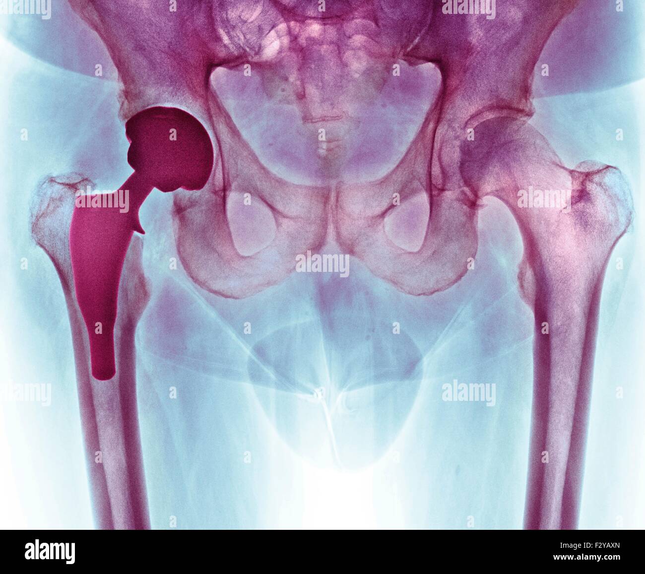 Hüftgelenkersatz. Farbig x-ray einen Schnitt durch die Becken-Region von einem 66 Jahre alten männlichen Patienten nach Hüftgelenkersatz-Operation. Hier, die prothetische Hüftgelenk (dunkel, links) kann gesehen werden, mit der Peg implantiert in den Femur (Mitte-links) und Ersatz-Buchse in der Hüfte (oben links). Stockfoto
