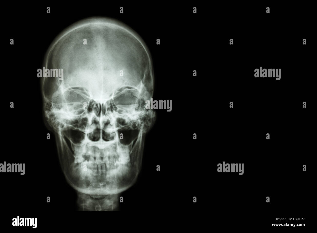 Film Röntgen Schädel des menschlichen und leeren Bereich auf der rechten Seite (Medizin, Wissenschaft und Gesundheitswesen Konzept und Hintergrund) Stockfoto