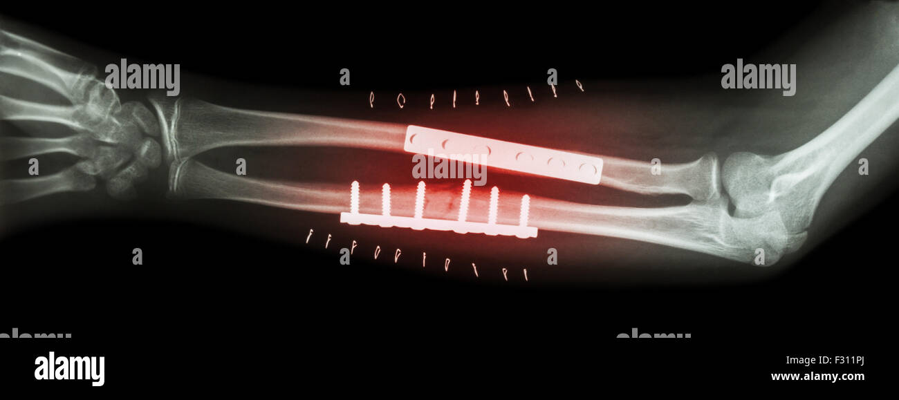 Bruch der beiden Knochen des Unterarms (ulnar und Radius).  Es wurde operiert und interne festgesetzten Platte und Schraube Stockfoto