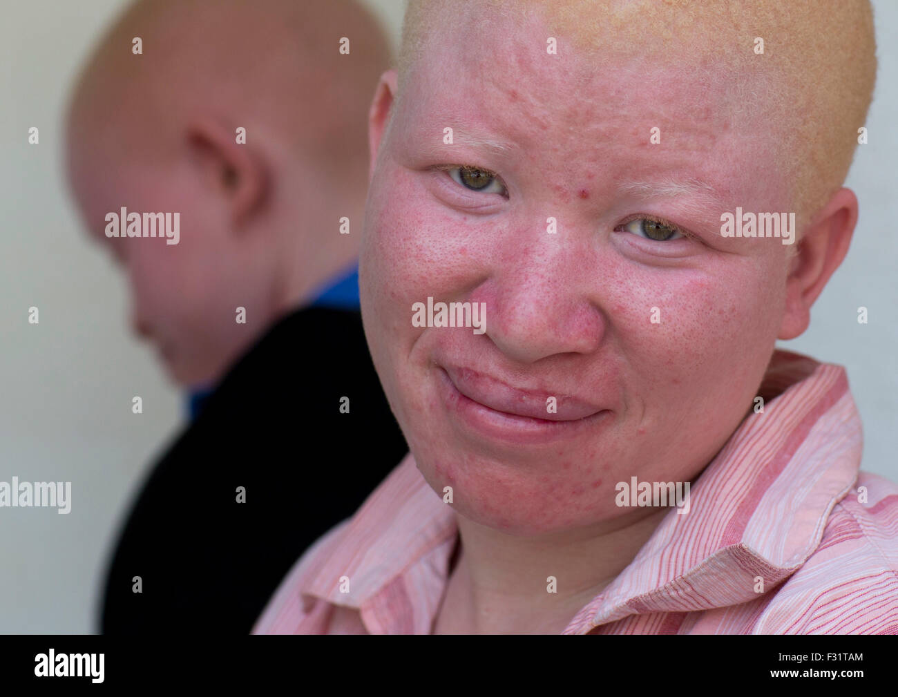 Albinism person africa Fotos und Bildmaterial in hoher Auflösung Alamy