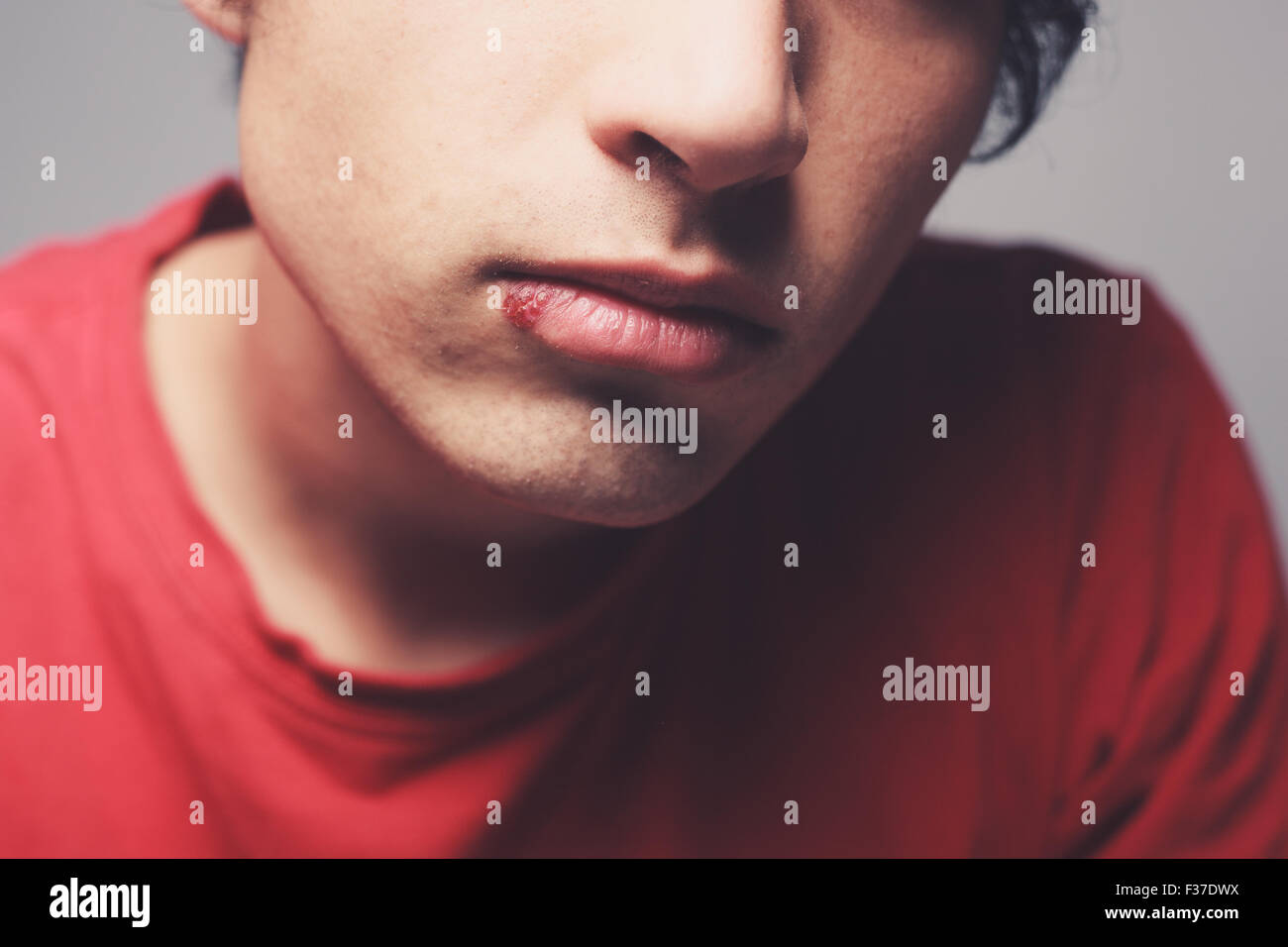 Junger Mann mit ein Herpesbläschen auf der Lippe Stockfoto