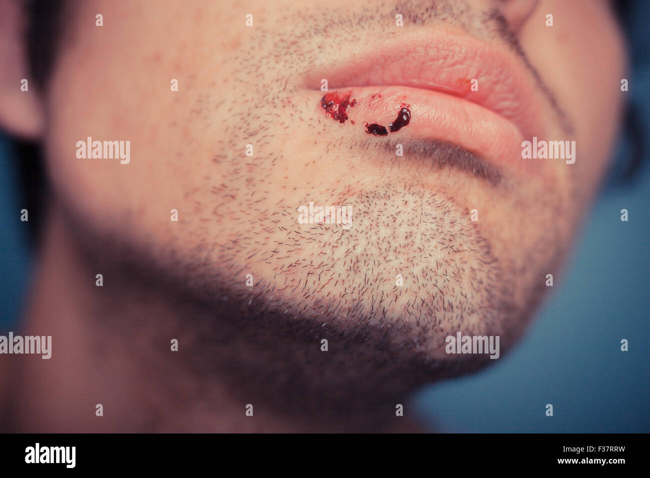 Junger Mann mit getrocknetem Blut aus ein Herpesbläschen auf der Lippe Stockfoto