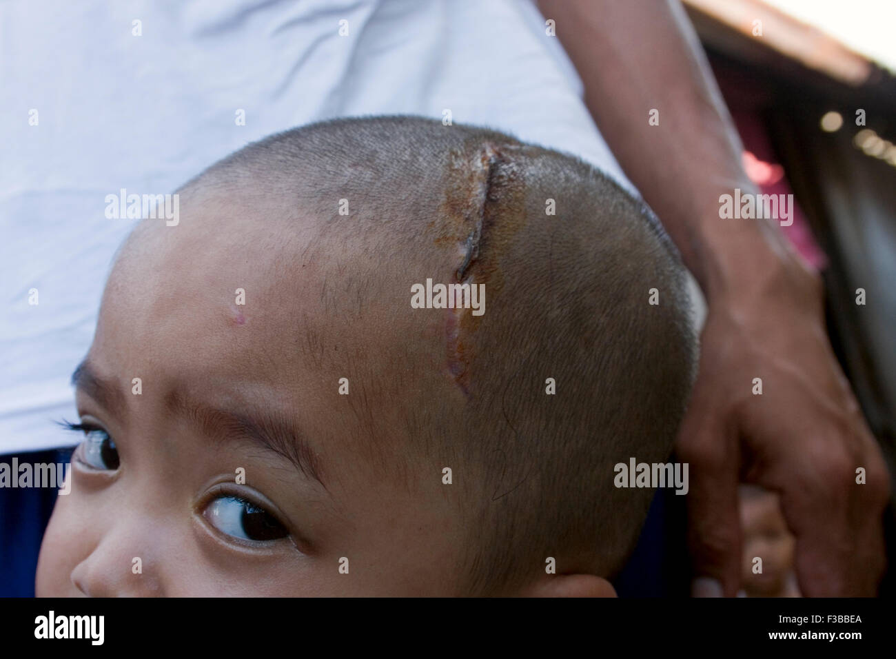 Ein junges Mädchen zeigt eine Narbe auf dem Kopf, nachdem Neurochirurgie Klinik Bopha in Phnom Penh, Kambodscha durchgeführt. Stockfoto