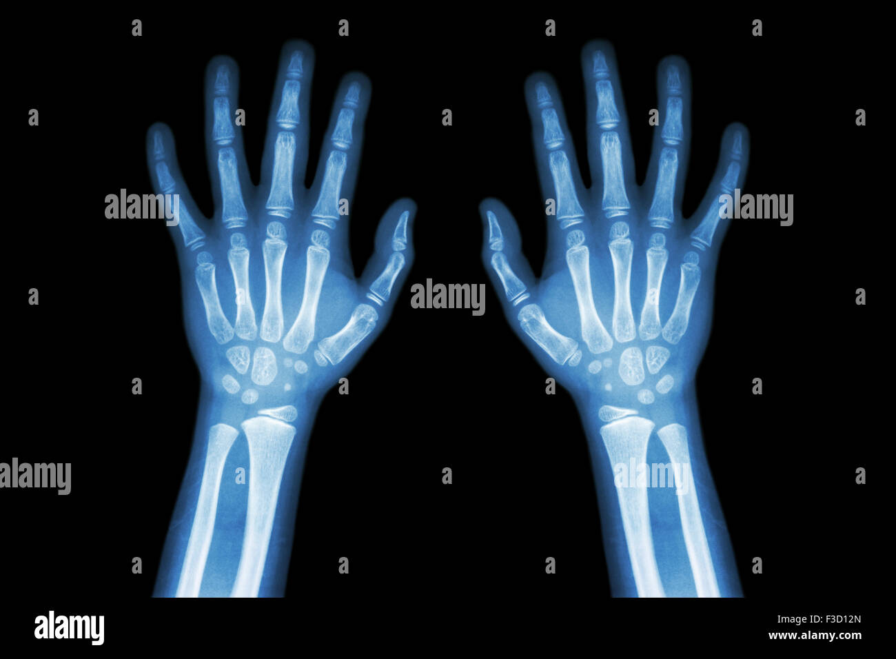 Child Hand X Ray Stockfotos und bilder Kaufen Alamy