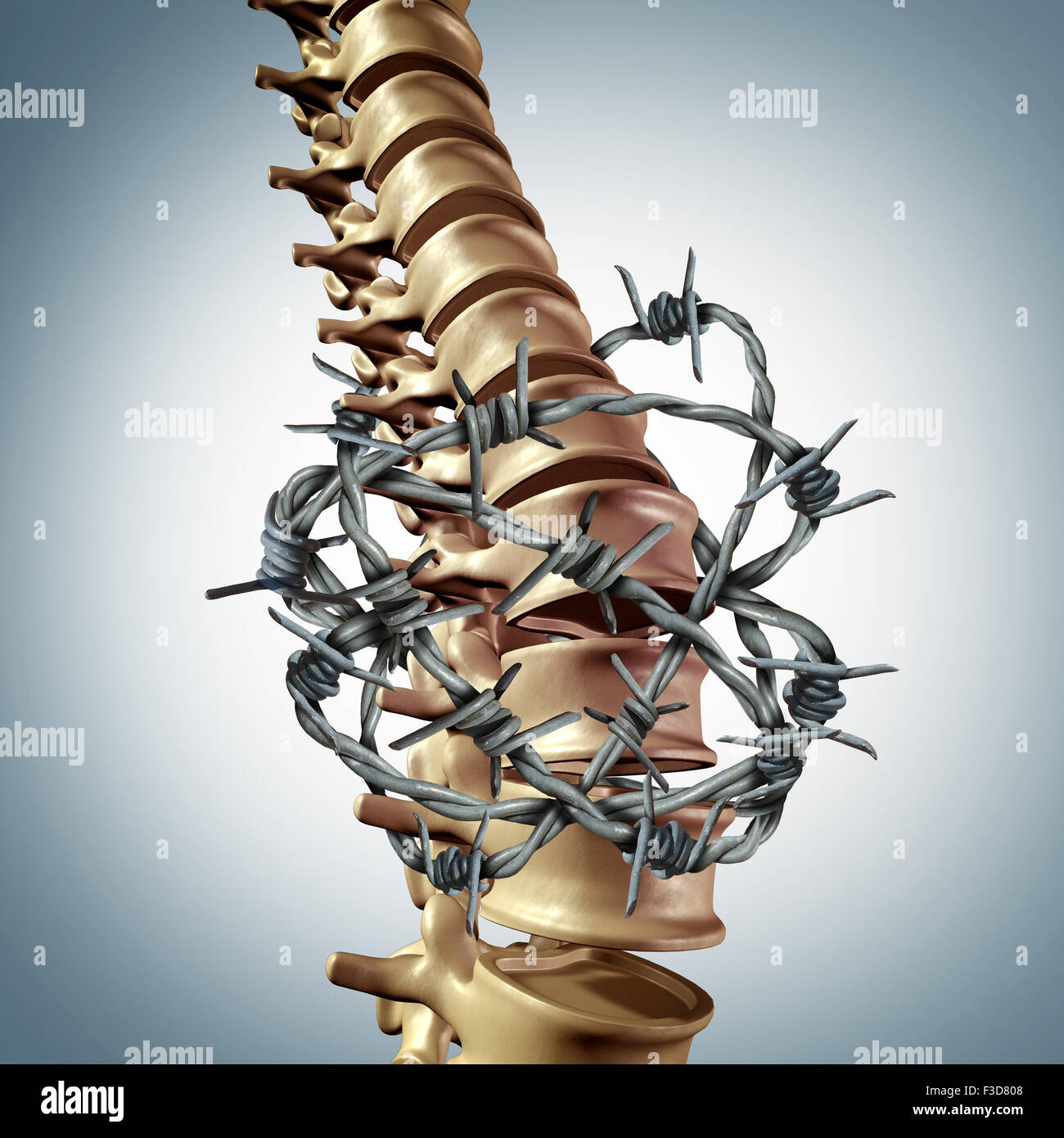 Tiefer Schmerz Krankheit und menschlichen Wirbelsäule Rückenschmerzen zurück mit einem drei dimensionalen Wirbelsäule Körper Skelett zeigt die Wirbel und Wirbelsäule Columnwrapped in Stacheldraht oder Stacheldraht als ein medizinisches Gesundheits-Konzept für die Belastung der Gelenke. Stockfoto