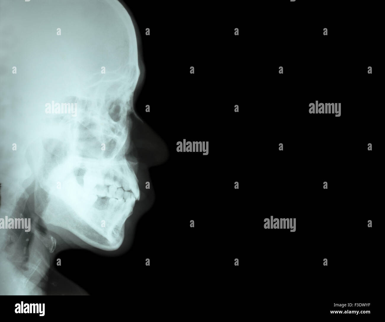 Film x-ray seitliche Nasenbein (Seitenansicht des Schädels) und leeren Bereich auf der rechten Seite Stockfoto