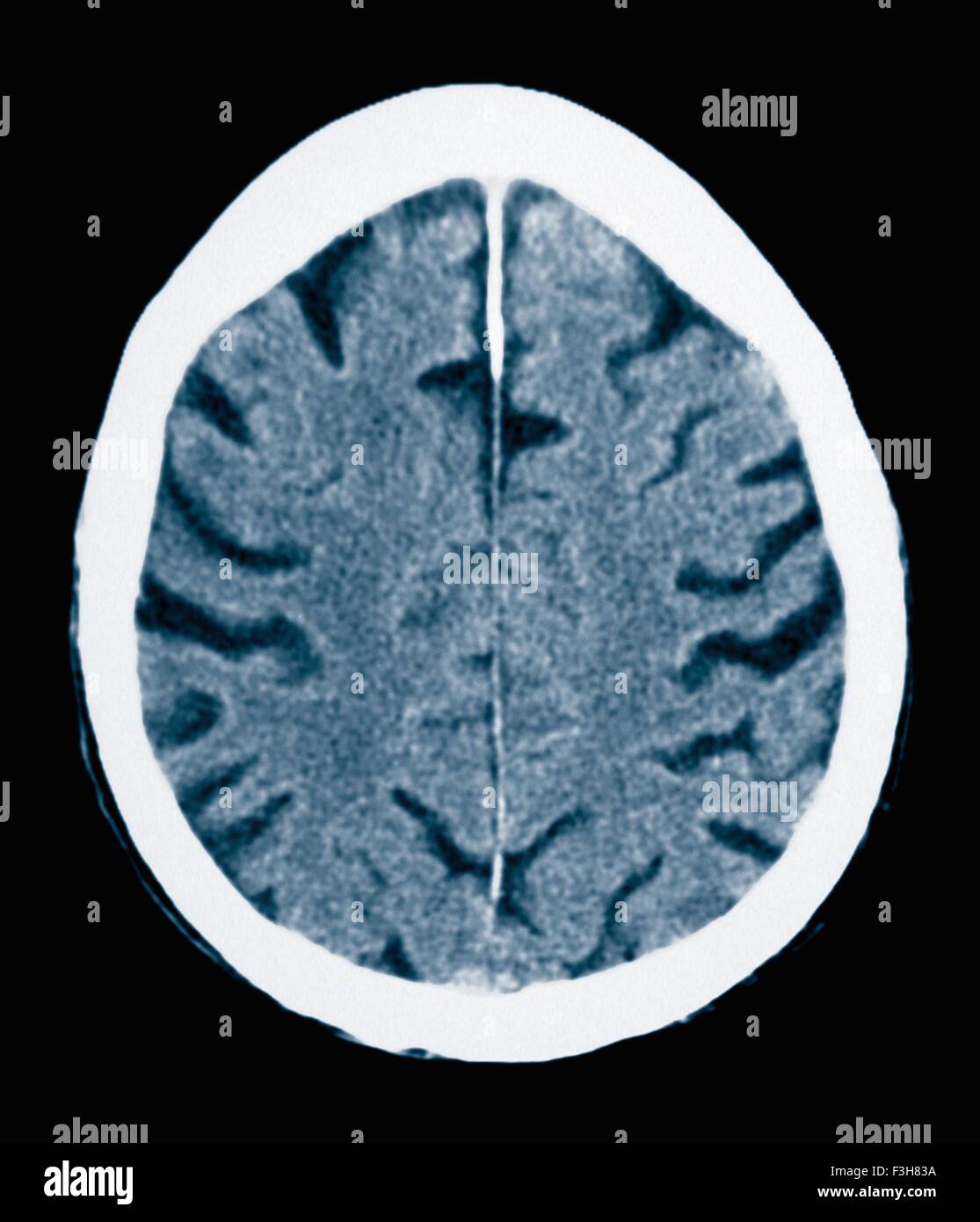 CT-Scan 84 Jahre alter Mann mit Alzheimer-Krankheit.  CT zeigt Hirnatrophie mit kleinen Windungen und großen Furchen Stockfoto