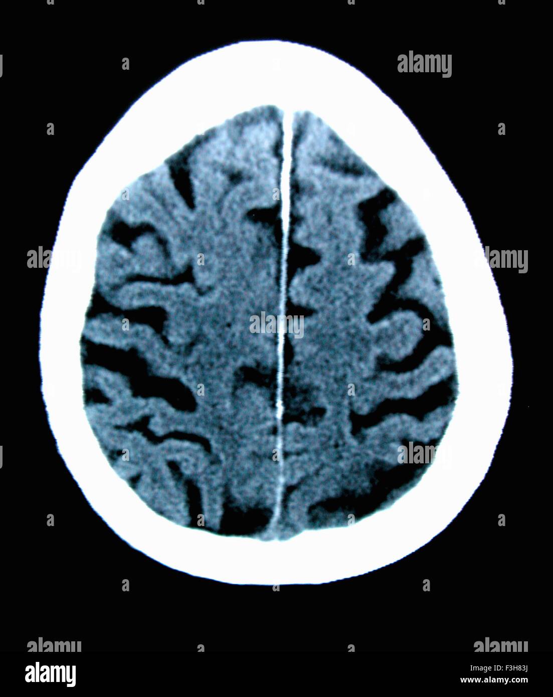 CT-Scan 84 Jahre alter Mann mit Alzheimer-Krankheit.  CT zeigt Hirnatrophie mit kleinen Windungen und großen Furchen Stockfoto