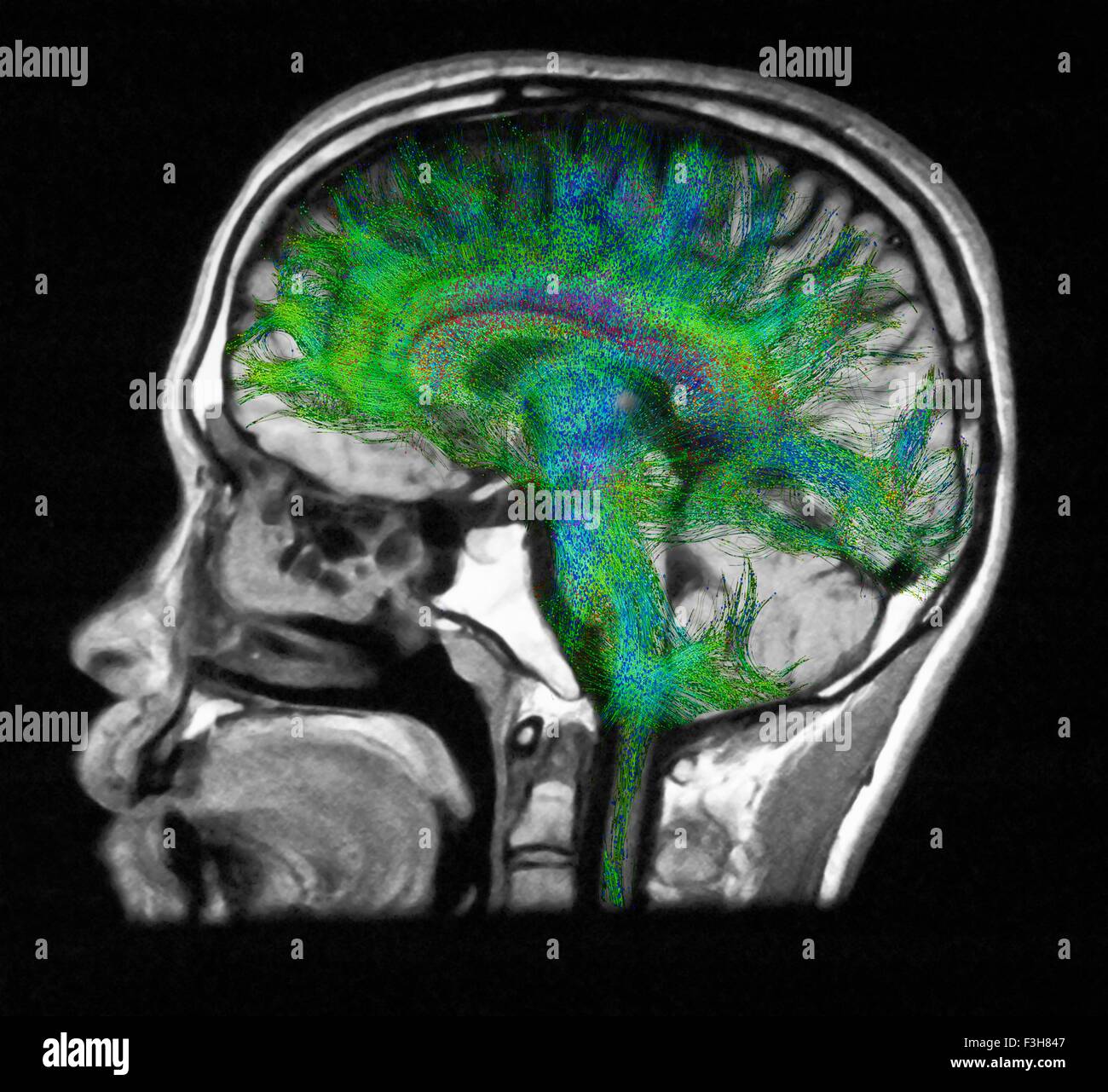 Verbreitung MRI, auch bezeichnet als Diffusion Tensor Imaging oder DTI, des menschlichen Gehirns Stockfoto