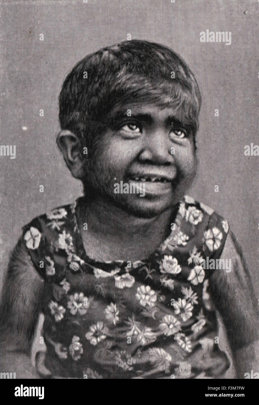 Krao Thai Kind angepriesen & ausgestellt als das fehlende Bindeglied in viktorianischen Zeiten, ca. 1885 Stockfoto