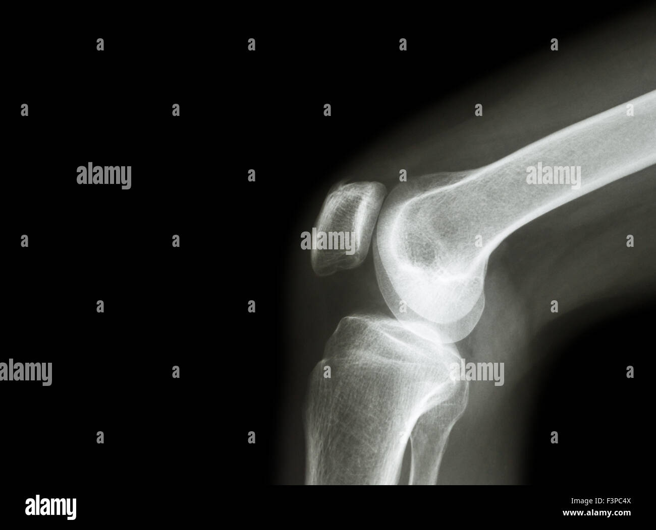 Film x-ray Kniegelenk bei Arthritis (Gicht, rheumatoide Arthritis, septische Arthritis, Arthrose Knie) und leeren Bereich im Stockfoto
