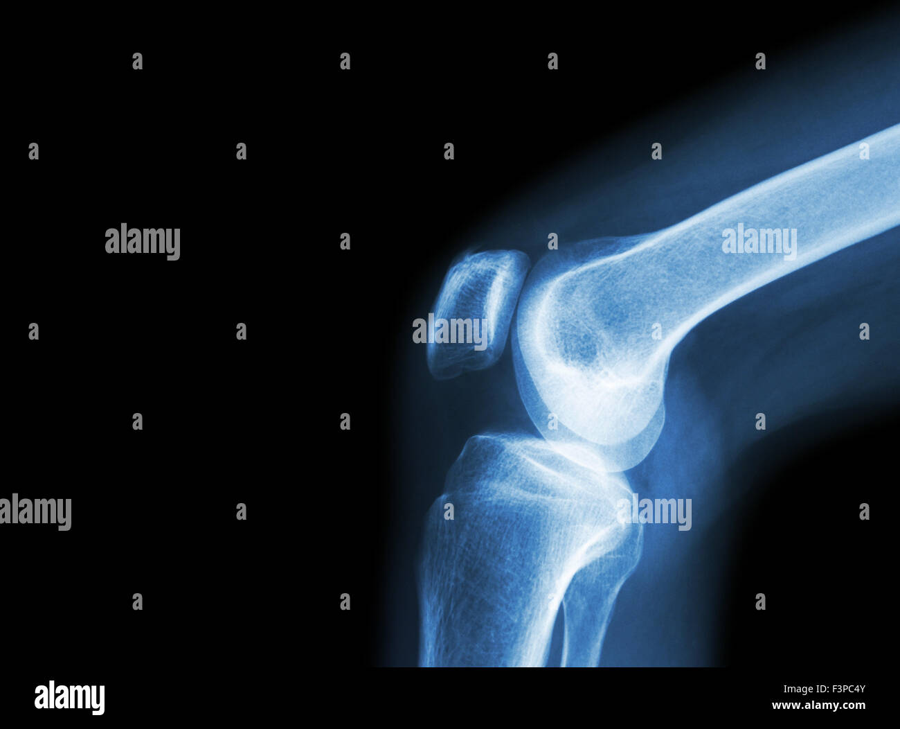 Film x-ray Kniegelenk bei Arthritis (Gicht, rheumatoide Arthritis, septische Arthritis, Arthrose Knie) und leeren Bereich im Stockfoto