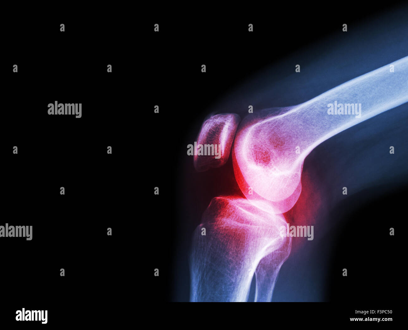 Film x-ray Kniegelenk bei Arthritis (Gicht, rheumatoide Arthritis, septische Arthritis, Arthrose Knie) und leeren Bereich im Stockfoto