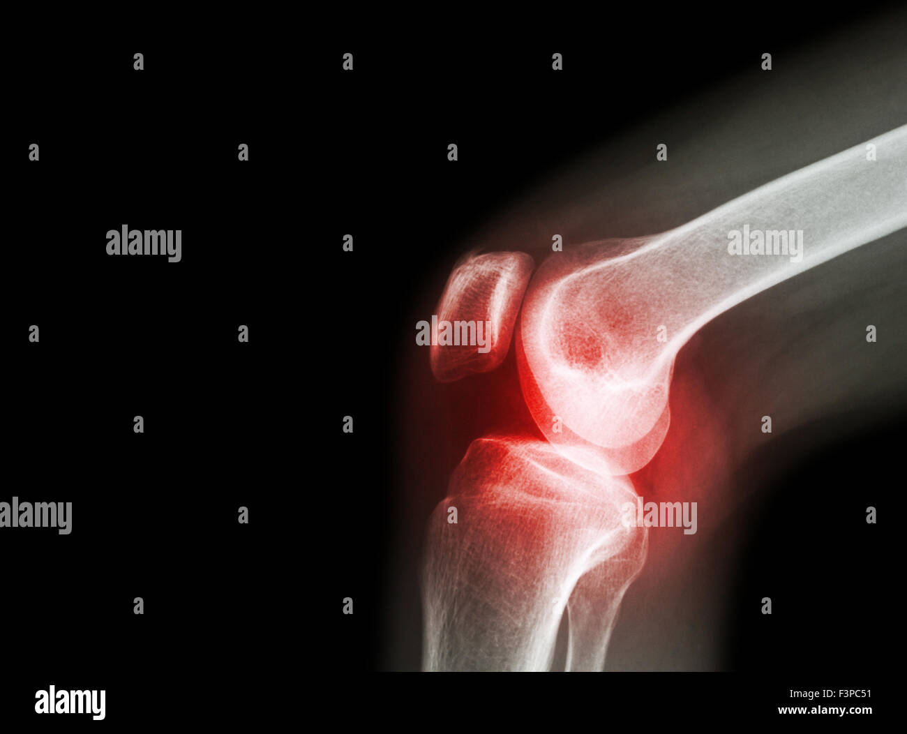 Film x-ray Kniegelenk bei Arthritis (Gicht, rheumatoide Arthritis, septische Arthritis, Arthrose Knie) und leeren Bereich im Stockfoto