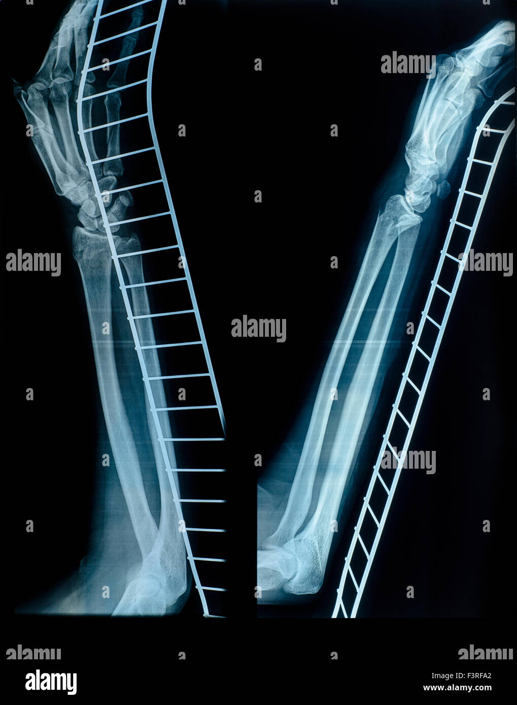 Röntgenbild der menschlichen Hand und Arm nach einem Bruch auf dem Metallträger. Ärztliche Untersuchung Stockfoto