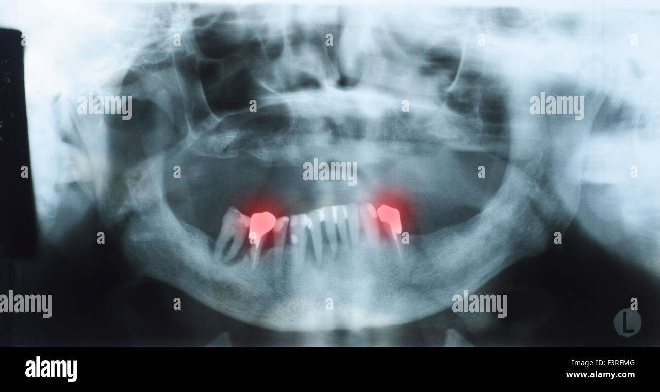 Panorama Zahnröntgen eine alte Person mit einigen unteren Zähne und kein Zahn der oberen. Prothese rot dargestellt. Auswahl Stockfoto