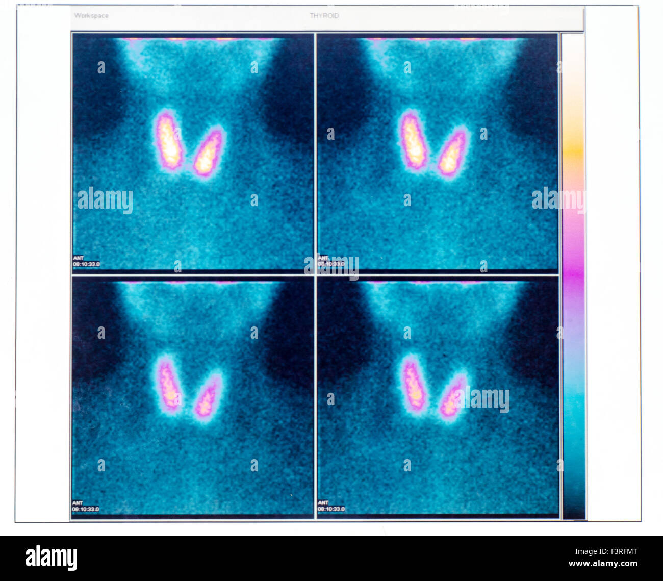 Szintigraphie der Schilddrüse mit zwei Knoten. Ärztliche Untersuchung Stockfoto