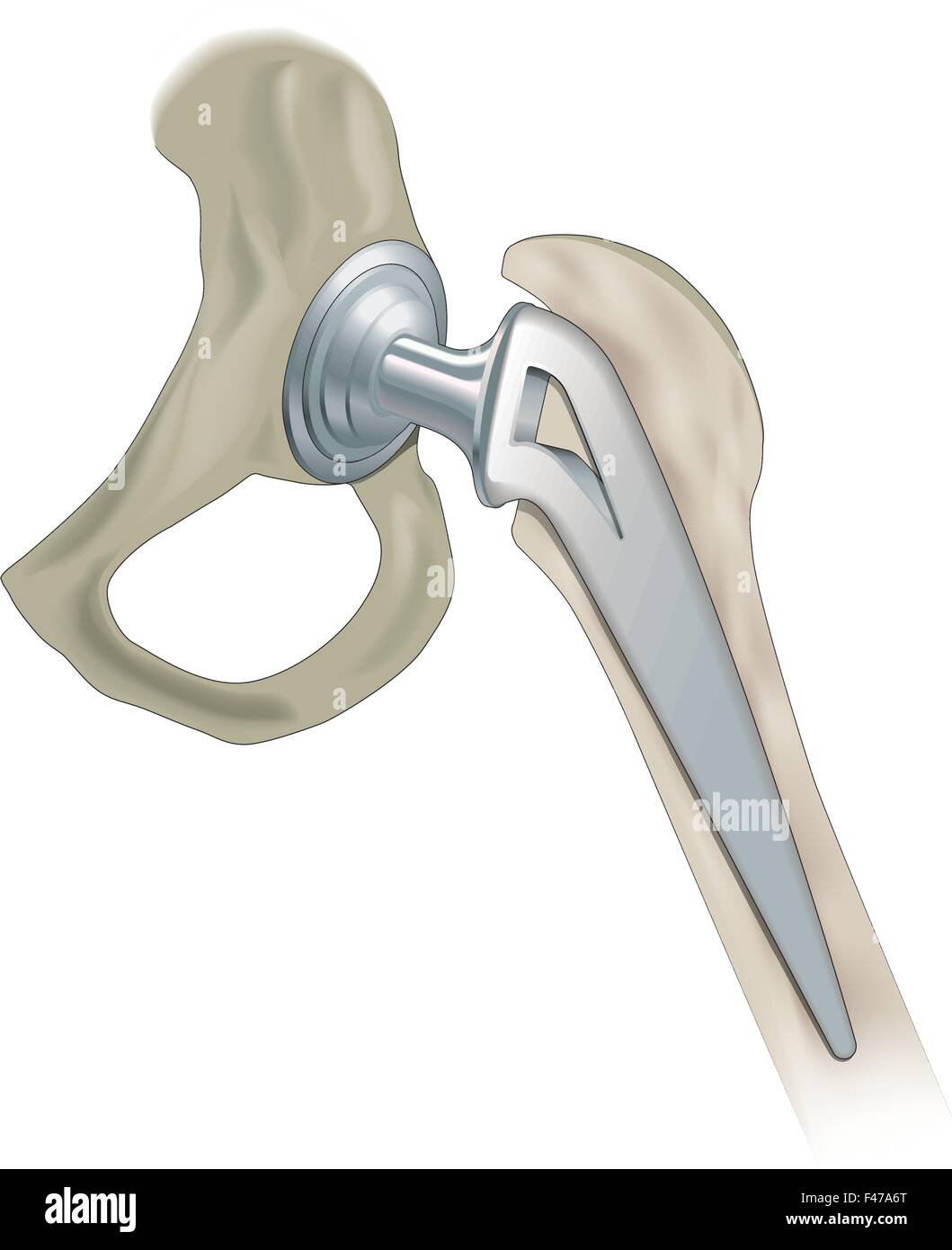 Биполярный сустав. Ревизионный эндопротез тазобедренного сустава. Двухполюсный эндопротез тазобедренного сустава. Головка эндопротеза тазобедренного сустава. Эндопротез мура цито.