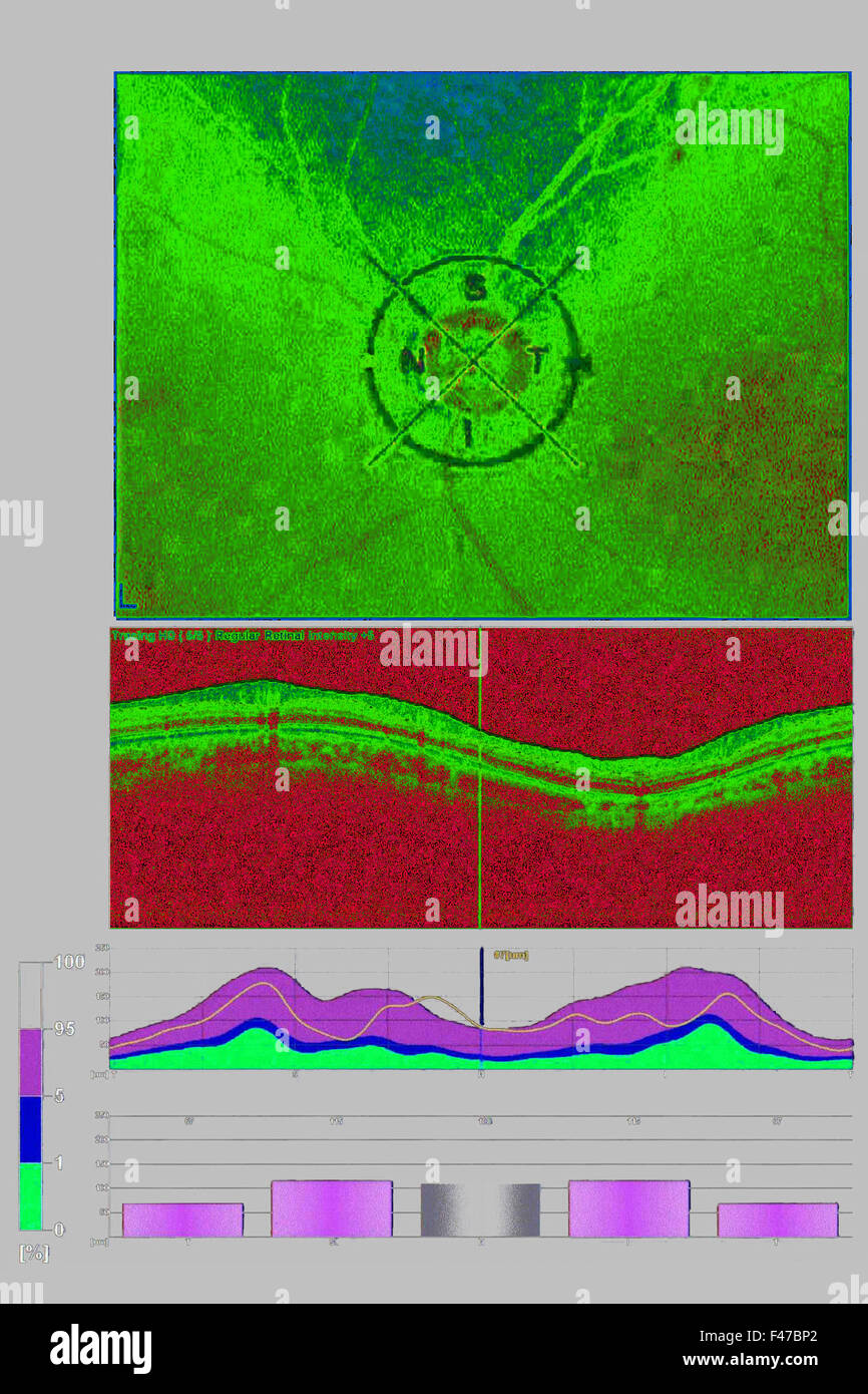 OPTISCHE KOHÄRENZTOMOGRAPHIE Stockfoto