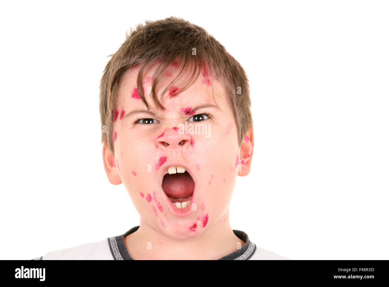 Junge ist an Windpocken erkrankt Stockfoto