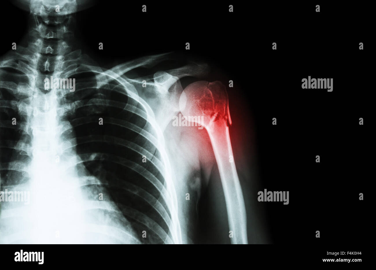 Fraktur am Hals des Humerus (Armknochen) (film Röntgen linken Schulter und leeren Bereich auf der rechten Seite) Stockfoto