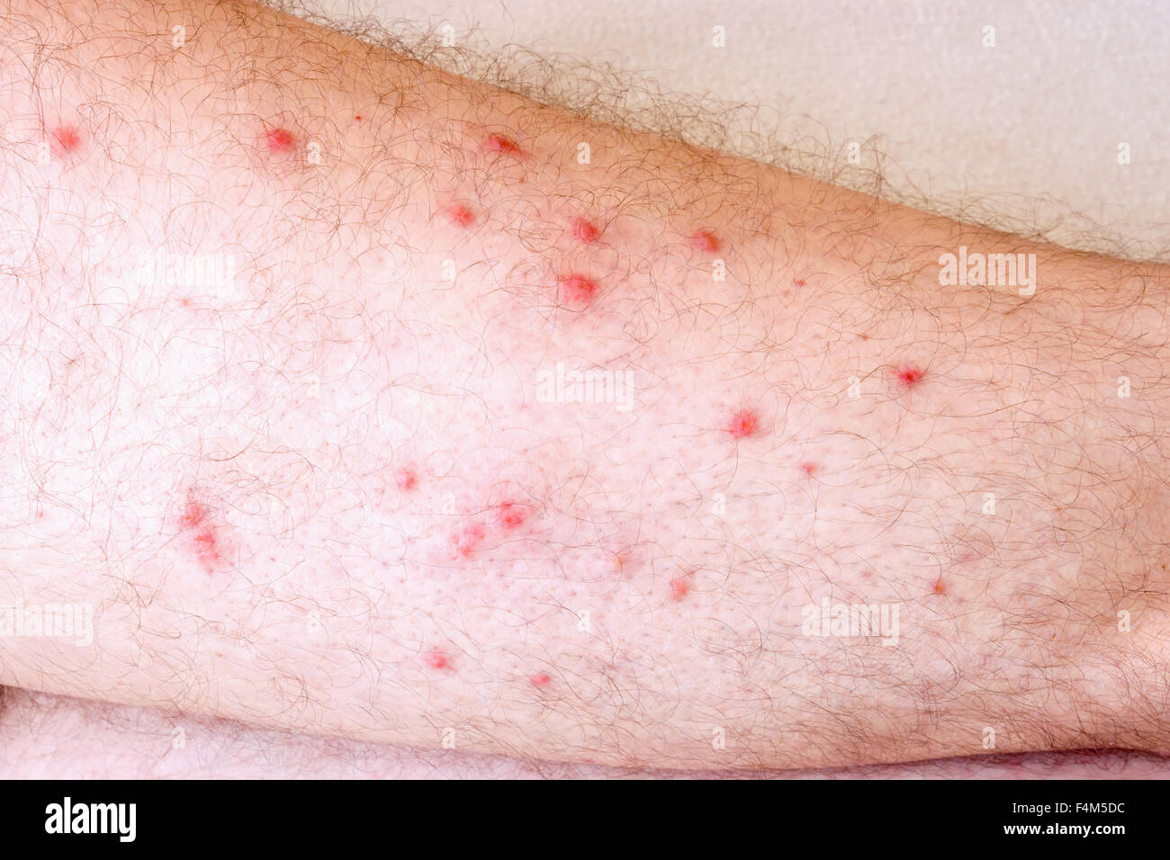 Allergische Reaktion auf das Bein Stockfotografie - Alamy