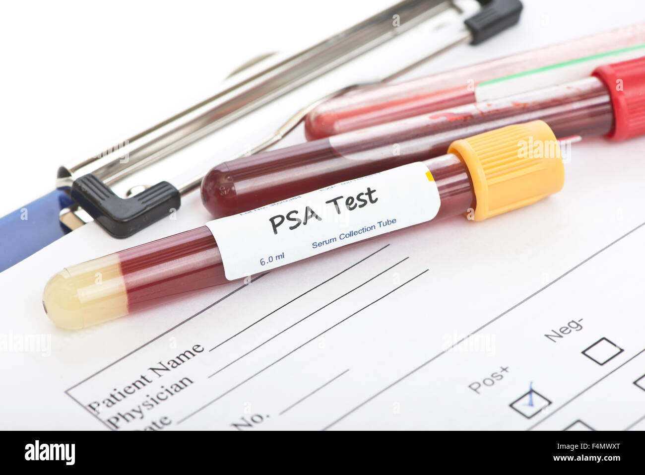 Prostata-spezifisches Antigen PSA Blut Kultur Sammlung Probenröhrchen mit Patientenakte. Stockfoto