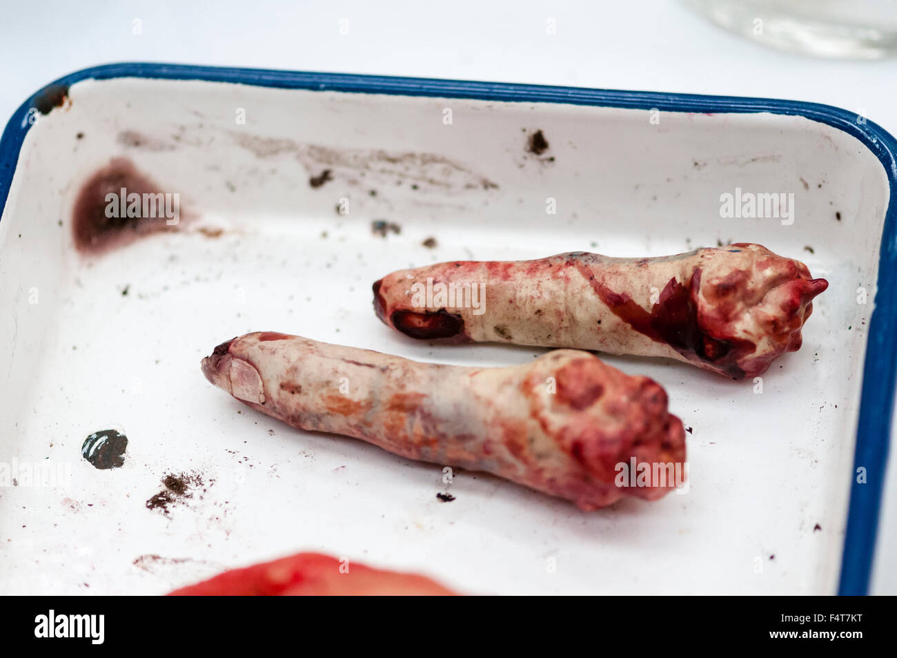Abgetrennten Fingern, das Ergebnis der eine improvisierte Explosive Gerät (IED), in einer schmutzigen emaillierte Schale in eine Armee medizinische Feldlazarett Stockfoto