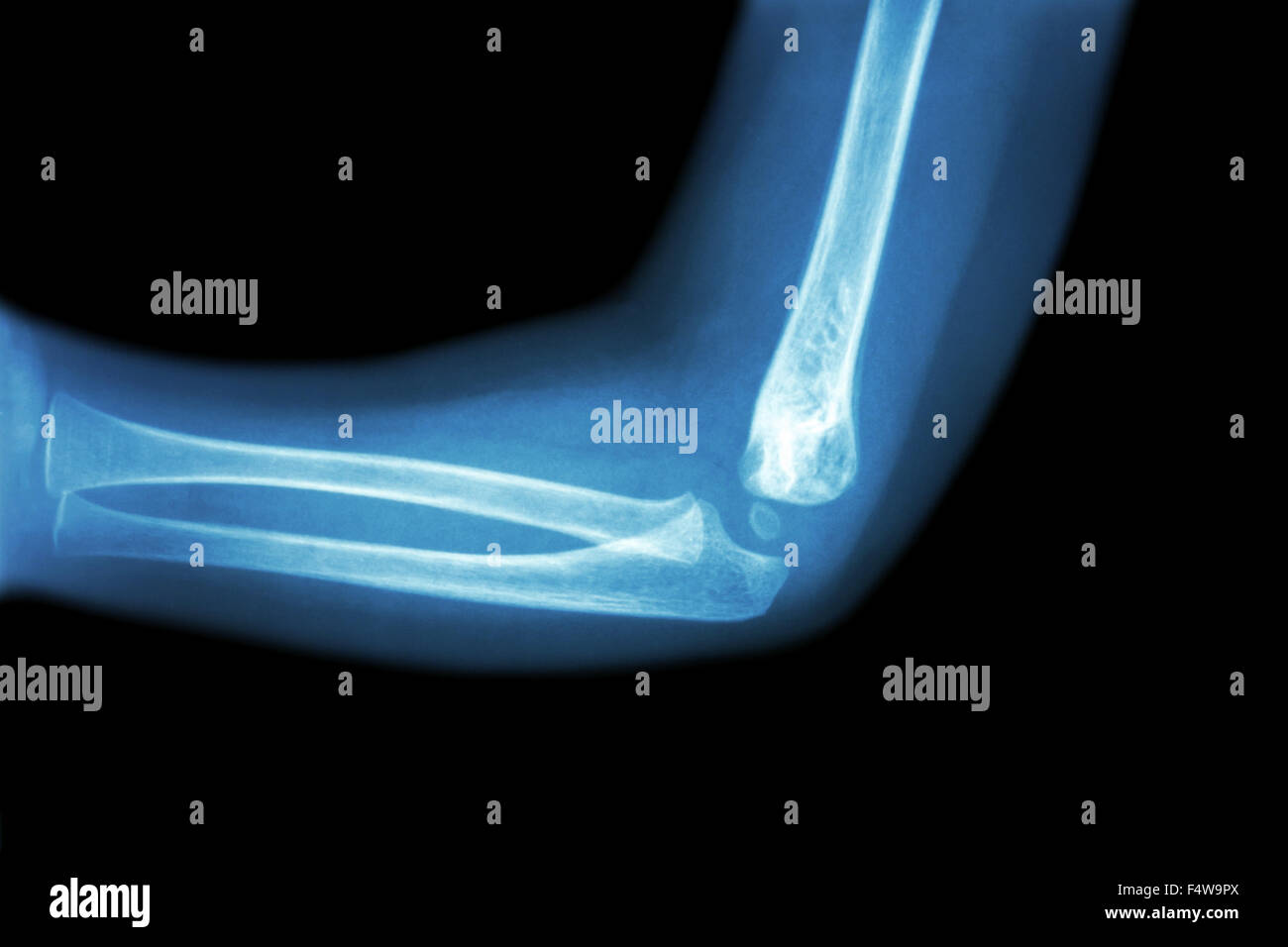 Roentgenfilm des Kindes Ellenbogen (normales Kind Ellenbogen) (Seitenansicht, Lateral) Stockfoto