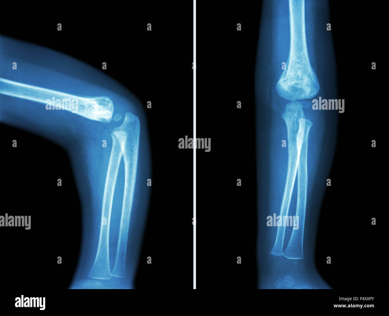 Roentgenfilm des Kindes Ellenbogen (normales Kind Ellenbogen) (seitlich und vorne, seitlich und anzeigen Anterior - Posterior-Ansicht) (2 postulieren Stockfoto