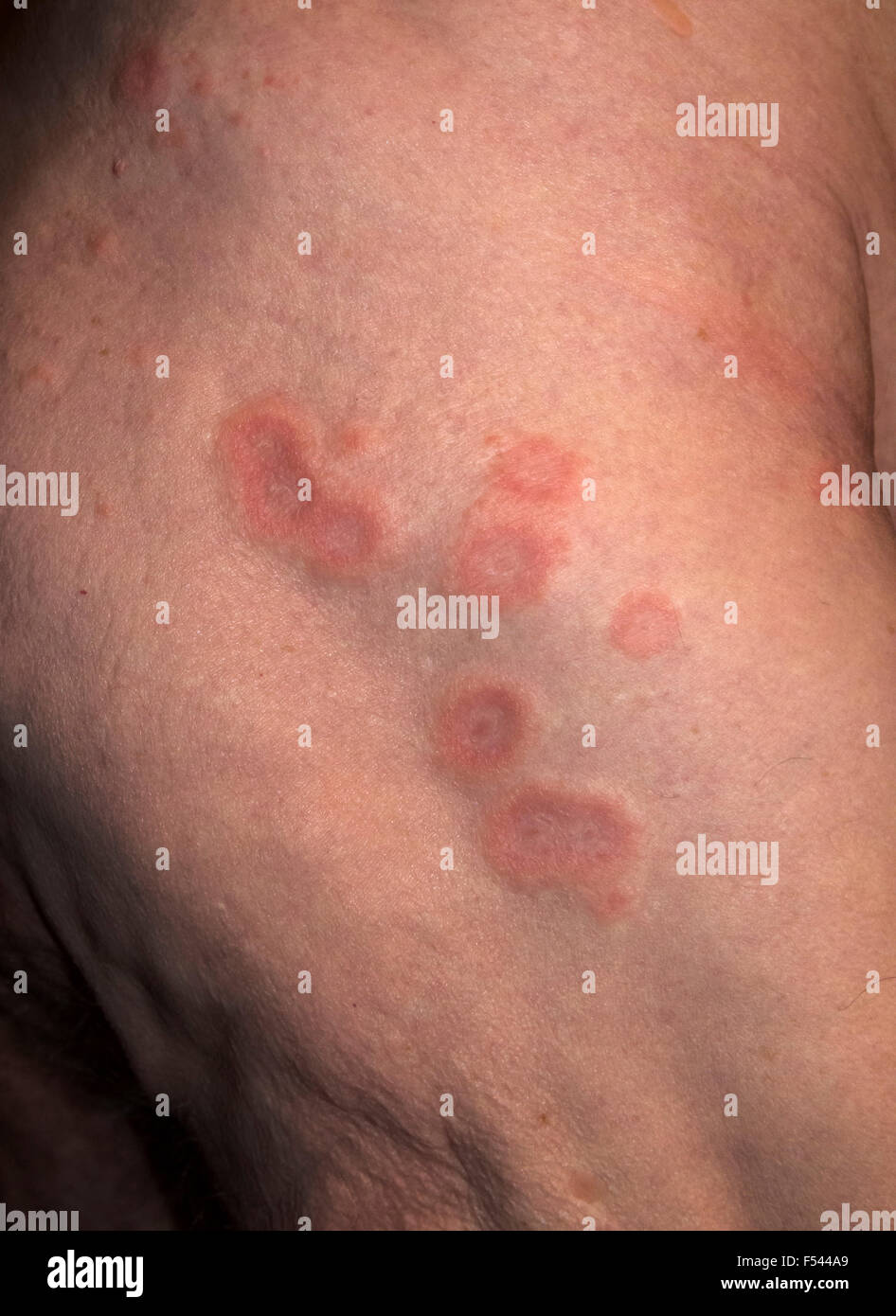 Tinea Hautzustand Ringelflechte Stockfotos Und Bilder Kaufen Alamy