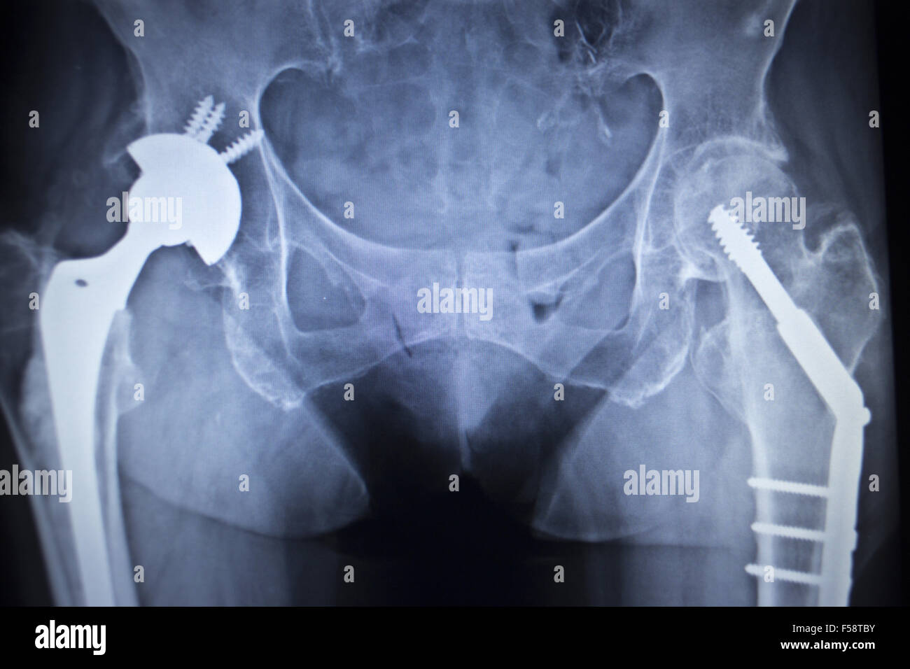 Orthopädie Skelett vom Hüftgelenk / Leiste mit Sehnen Rückansicht von  Hinten Photos