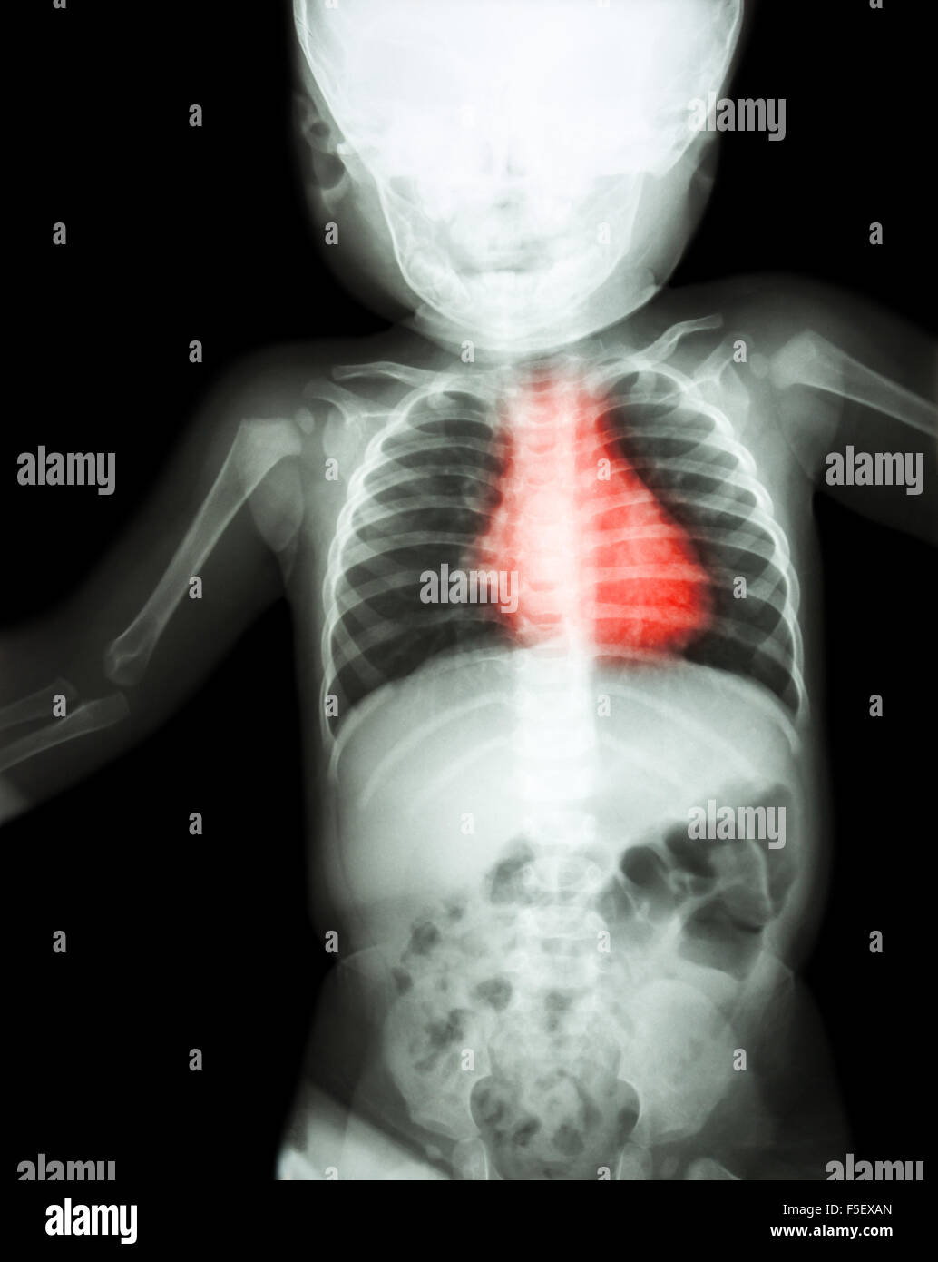 Röntgen-ganze Kind Körper mit Herz-Kreislauferkrankungen (rheumatischen Herzkrankheit, Herzklappenerkrankungen) Film (Herz-Kreislauf-System) Stockfoto