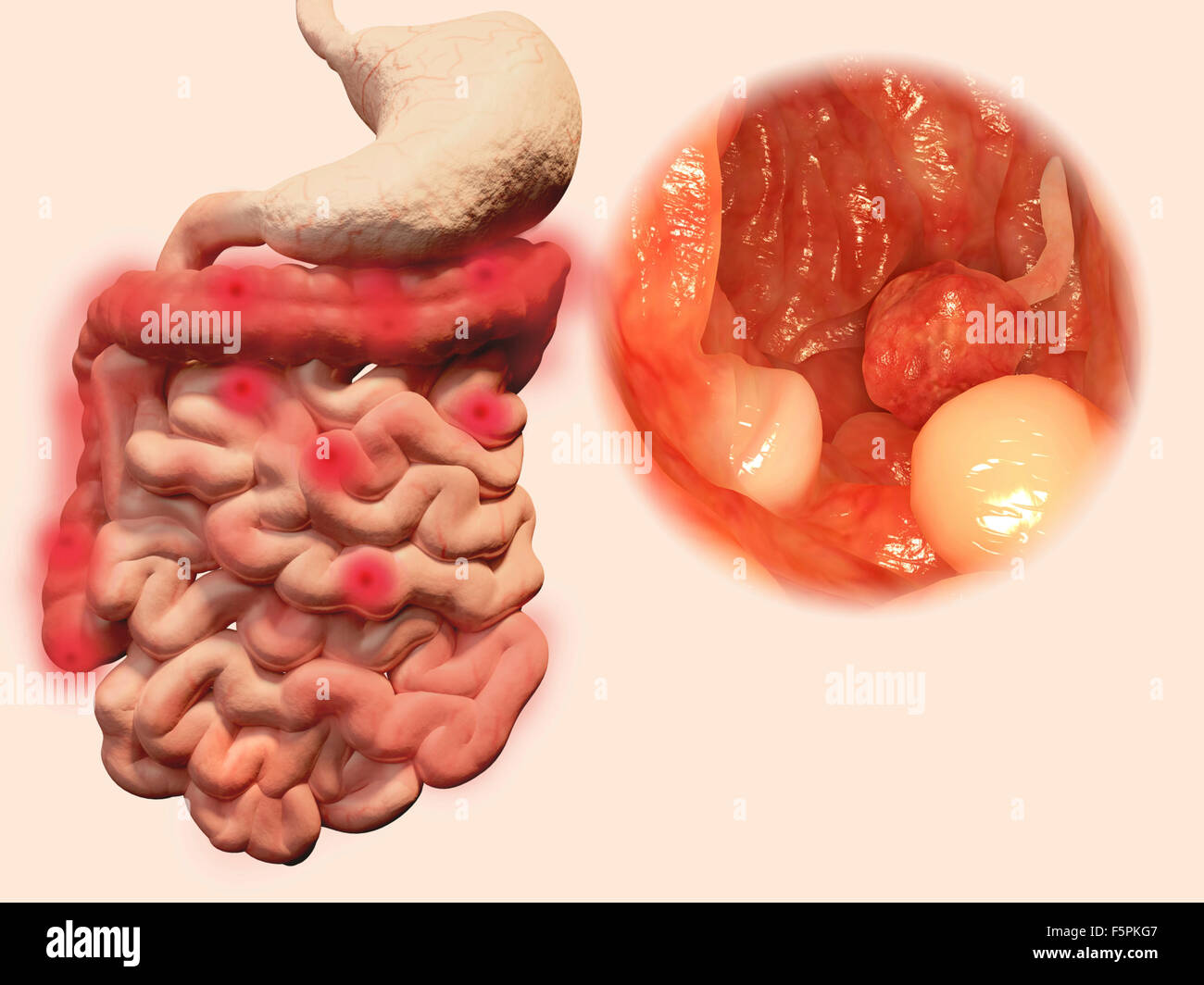 Darmpolypen Computer Bild Polypen Sind Eine Abnorme Wachstum Von Gewebe Obwohl Gutartig Nicht Krebsartige Gibt Es Eine Stockfotografie Alamy