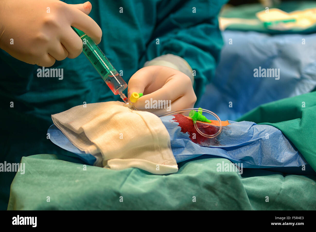 Katheterablationsverfahren im Universitätsklinikum Schwester von Mercy in Zagreb, Kroatien Stockfoto