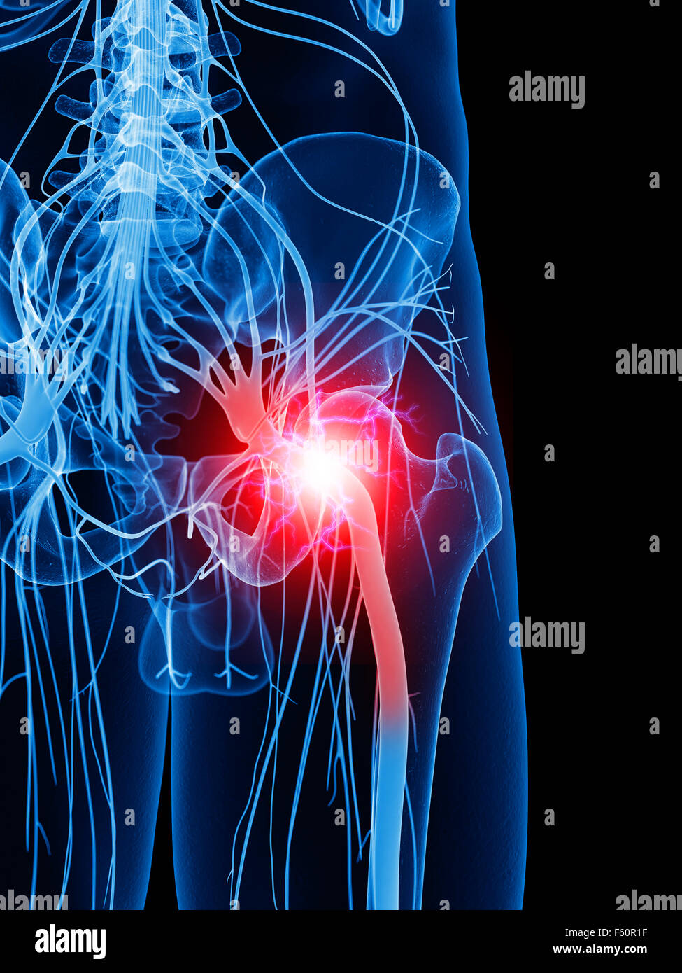 medizinisch genaue Abbildung von einer schmerzhaften Ischiasnerv Stockfoto