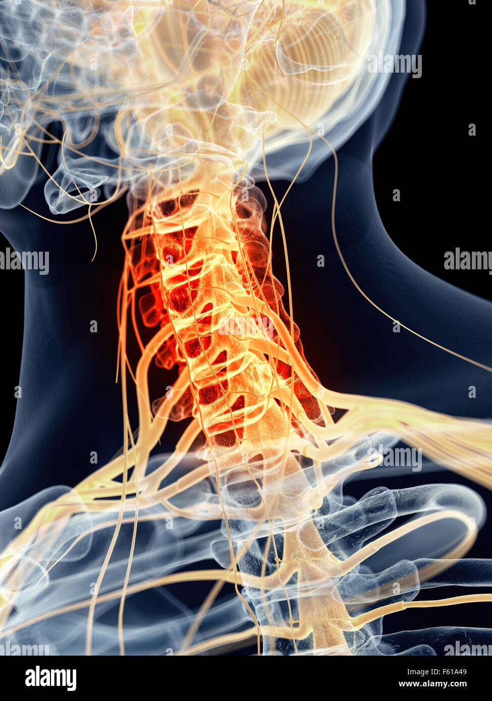 medizinisch genaue Abbildung - schmerzhafte zervikale Nerven Stockfoto