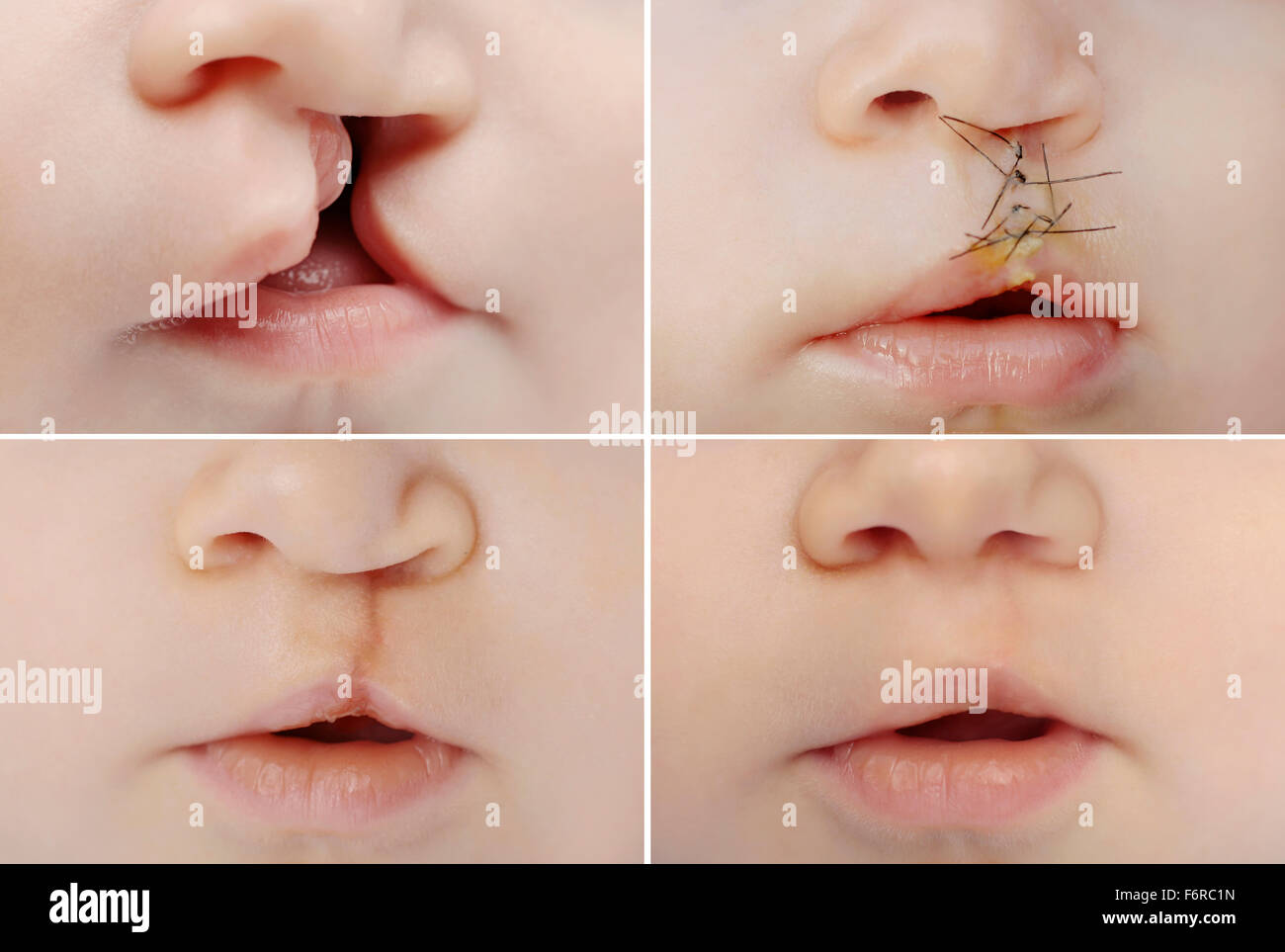 4 Nahaufnahme Bilder von Babys mit Lippen-Gaumen Spalte vor und nach der Operation Stockfoto