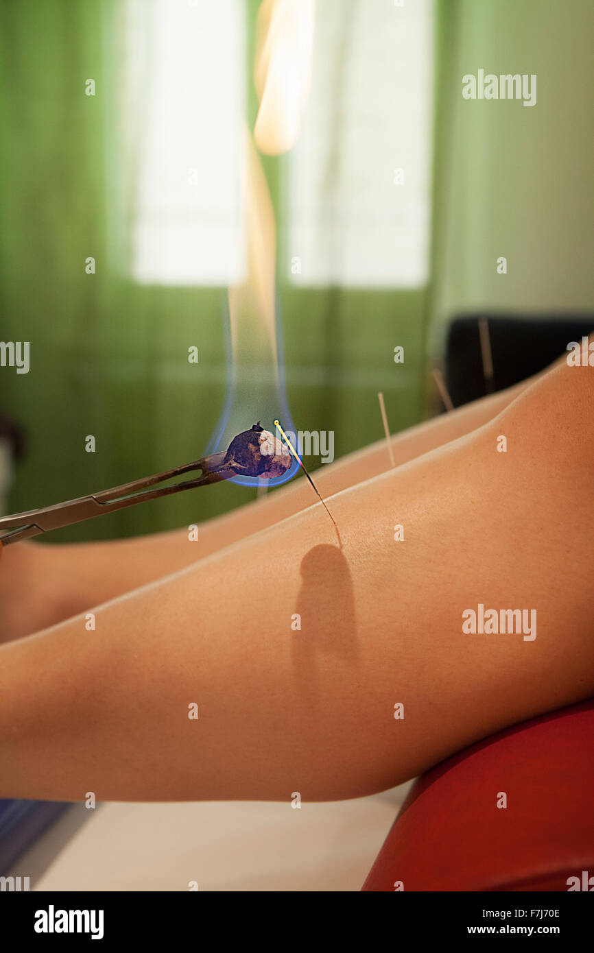Reportage über einen Therapeuten, der in der traditionellen chinesischen Medizin spezialisiert ist. Der Therapeut vereint Nadeln und Moxibustion, die Nadeln Heizung ermöglicht die Akupunkturpunkte stimuliert zu werden mehr Stockfoto