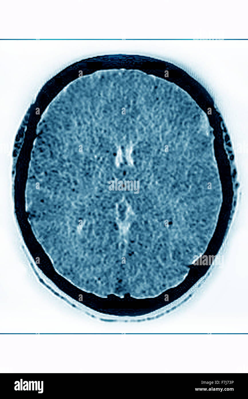 GEHIRN-ÖDEM CT-SCAN Stockfoto