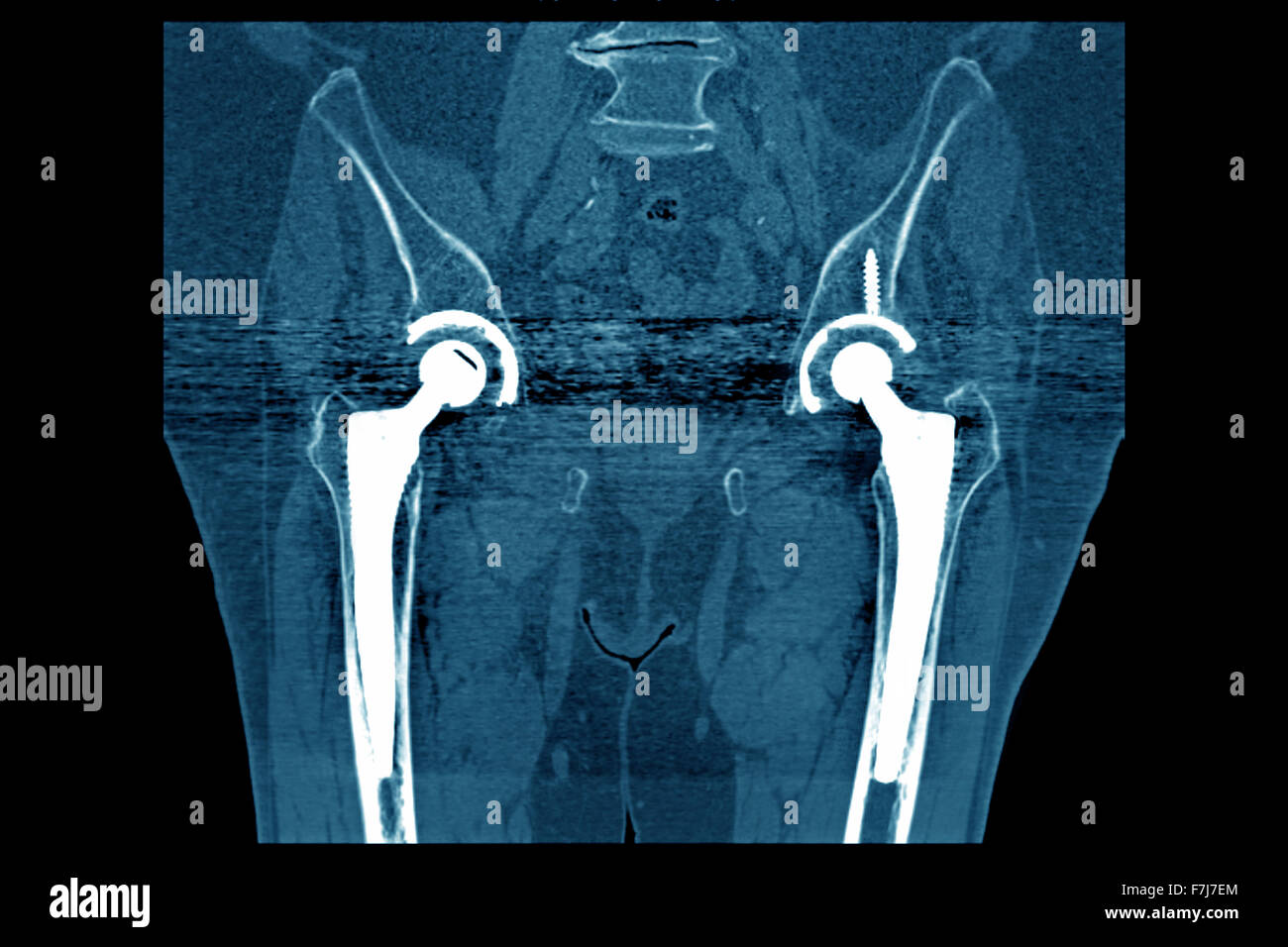 HÜFT-PROTHESE, CT-SCAN Stockfoto