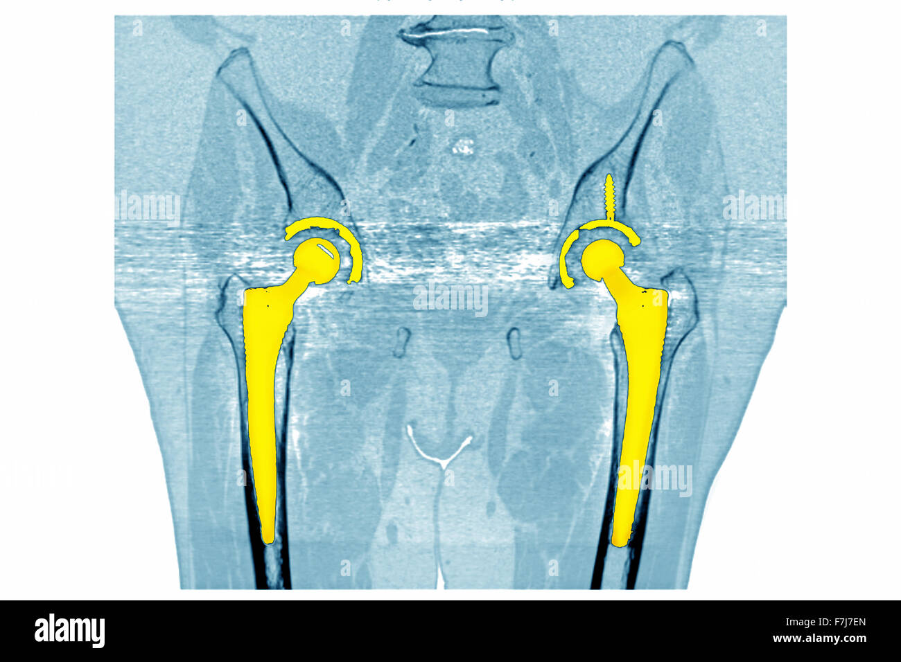 HÜFT-PROTHESE, CT-SCAN Stockfoto