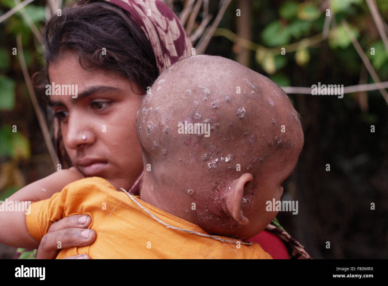 Flut betroffenen Norden Bangladesch. Chamilly im Alter von 20 mit Baby Shuboh im Alter von 16 Monaten mit Infektion der Haut von verunreinigtem Wasser. Stockfoto