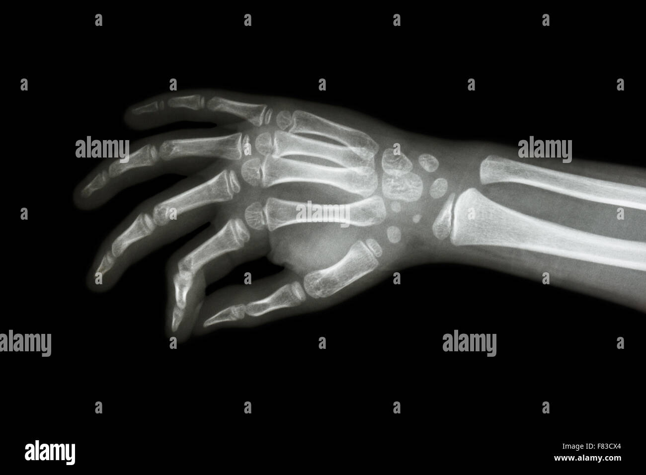 Film x-ray Hand des Kindes (Schrägansicht) Stockfoto