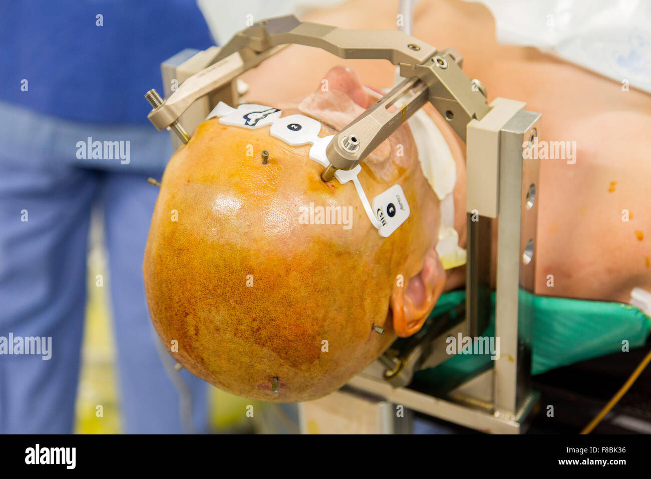 Chirurgische Behandlung der Parkinson-Krankheit durch tiefe Hirnstimulation mit Rosa® Roboter, Krankenhaus in Amiens, Frankreich. Stockfoto