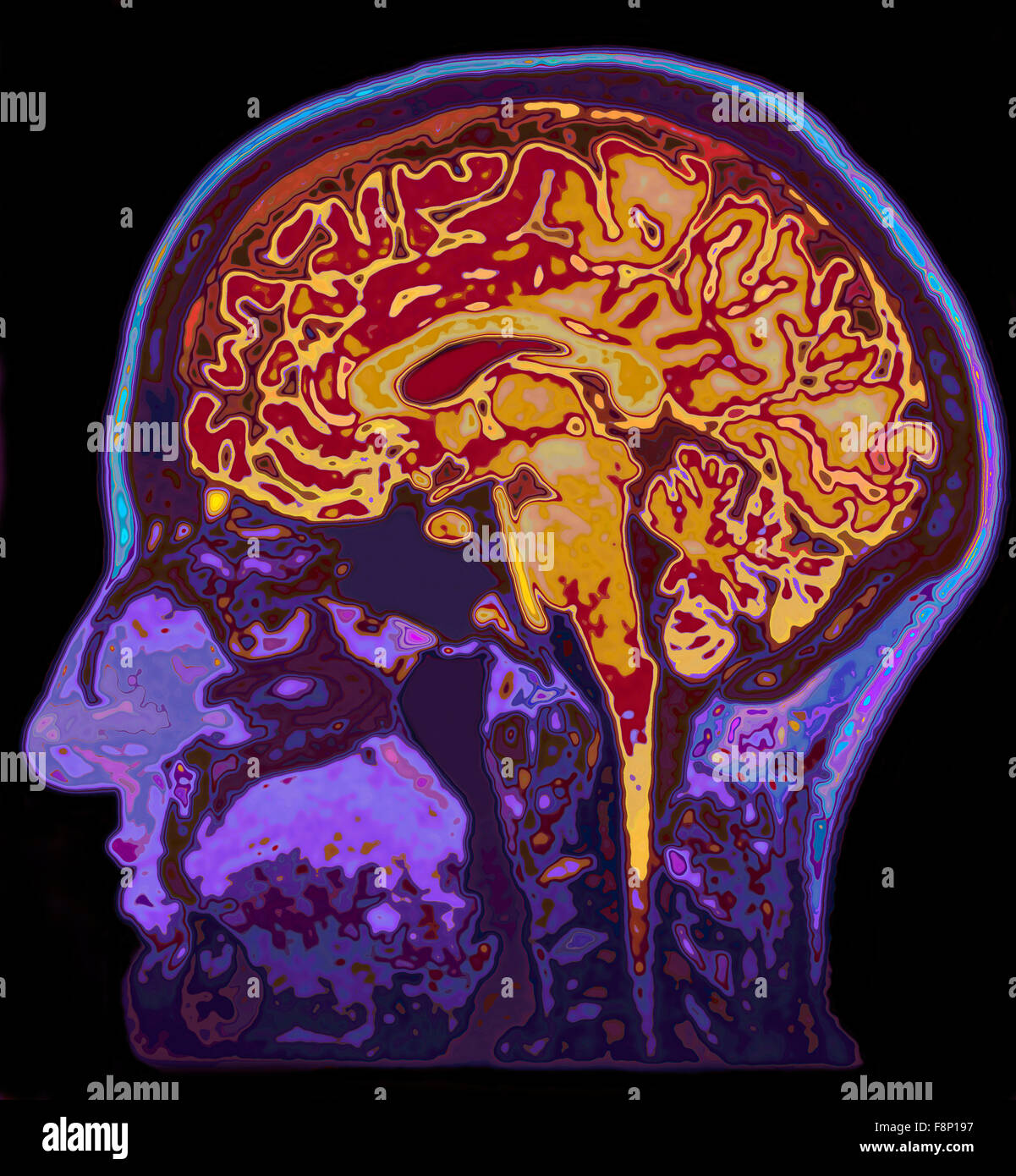 MRI-Bild des Kopfes zeigt Gehirn Stockfoto