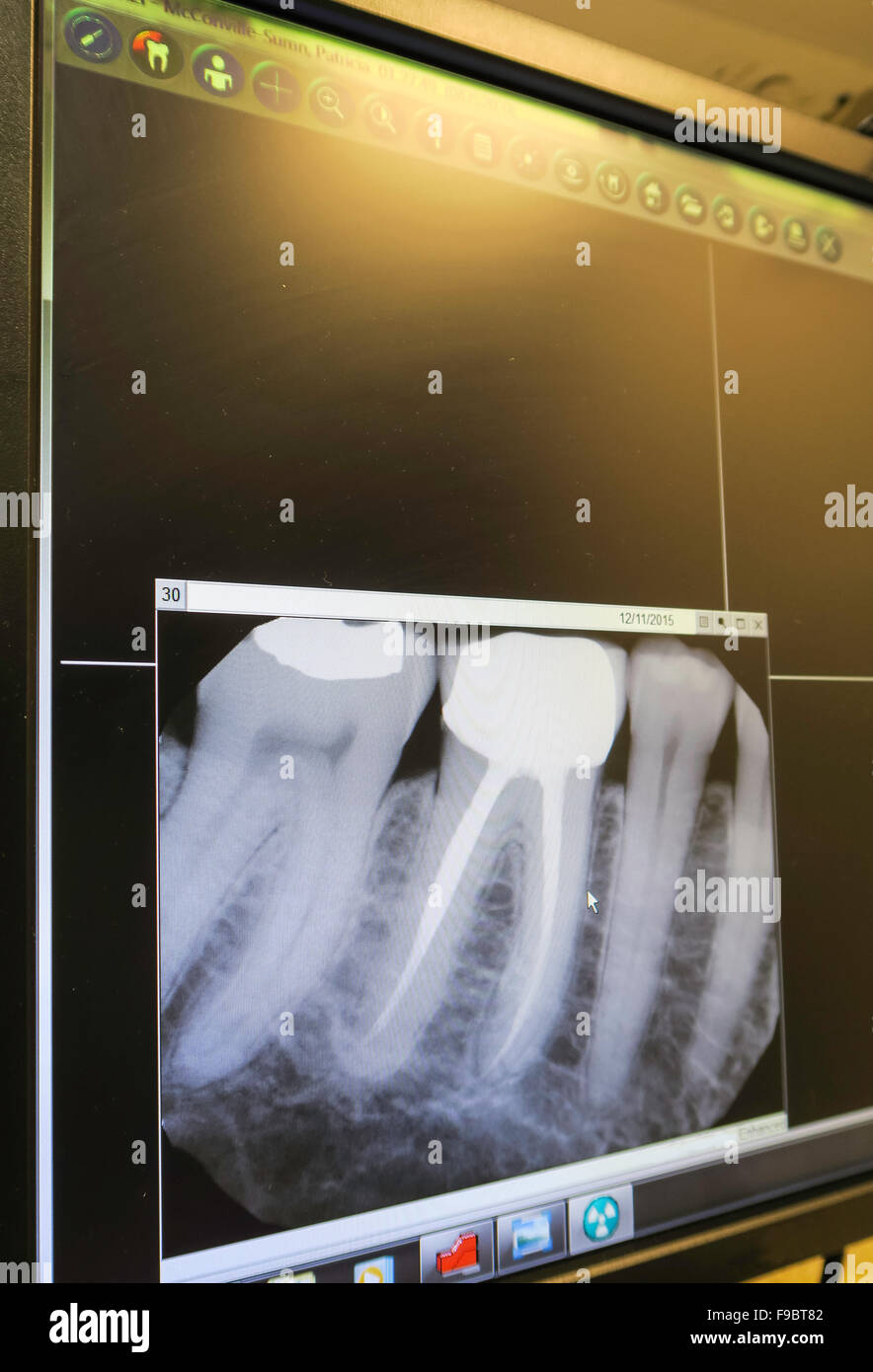 Röntgenaufnahme des erfolgreichen Wurzelbehandlung, Dental Office, USA Stockfoto