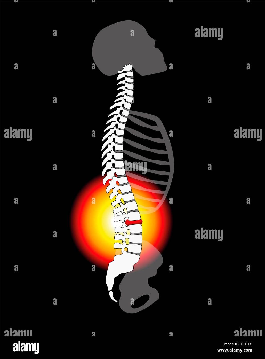 Schmerzen im Rücken - Wirbelsäule Bandscheibenvorfall oder Prolaps bei einer menschlichen Wirbelsäule - Höhenplan. Stockfoto