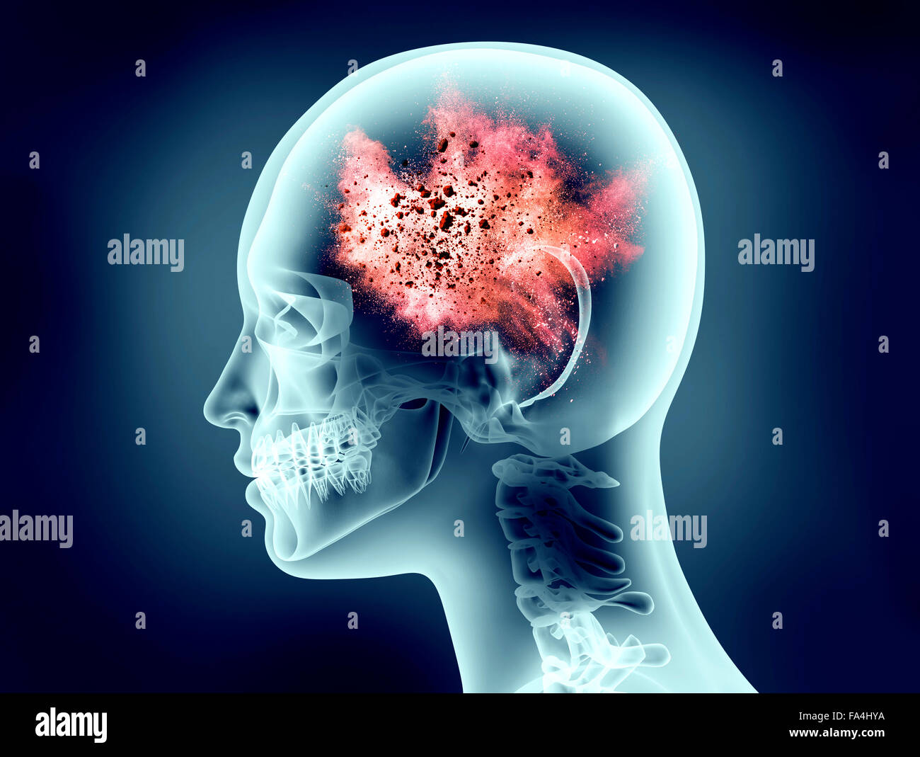 Röntgenbild des menschlichen Kopfes mit explosion Stockfoto