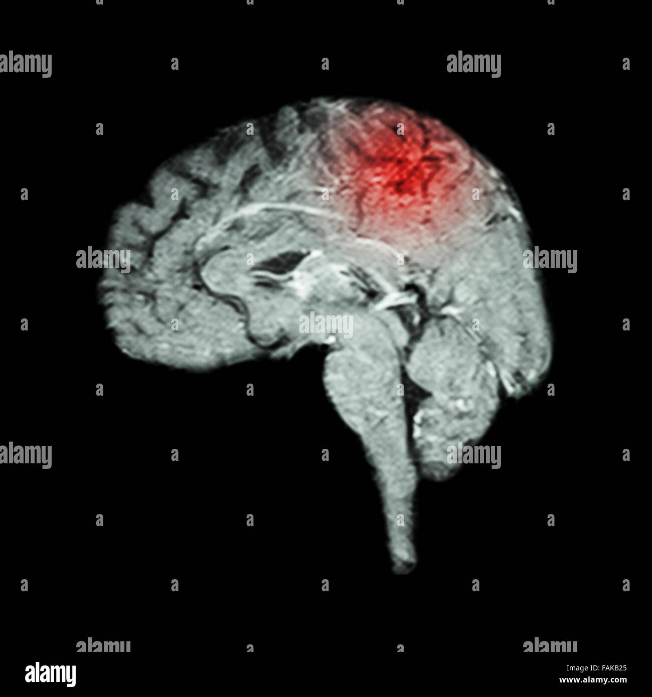 Magnet-Resonanz-Tomographie (MRT) des Gehirns und Schlaganfall (Medizin, Wissenschaft und Gesundheitswesen Konzept) Stockfoto